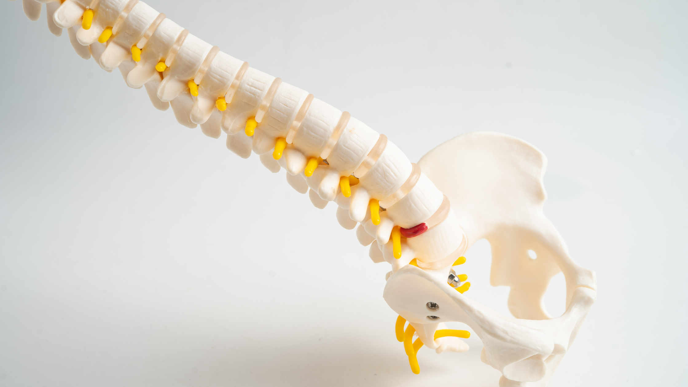 degenerative arthritis in the spine